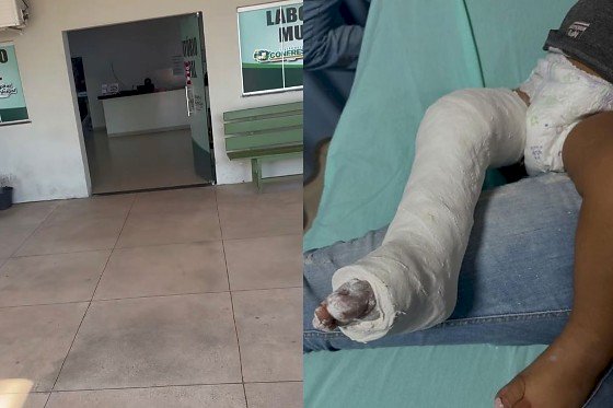 Criança sofre fratura após ser atingida por estrutura provisória em hospital de Confresa