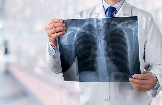 Casos de Síndrome Respiratória Aguda Grave começam a cair após cinco meses de alta no Brasil